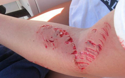 How to deal with fish-related injuries - Boat Angling